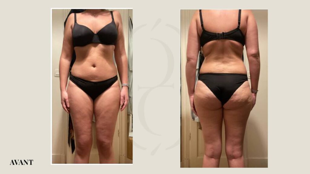 avant résultat cocon infrarouges